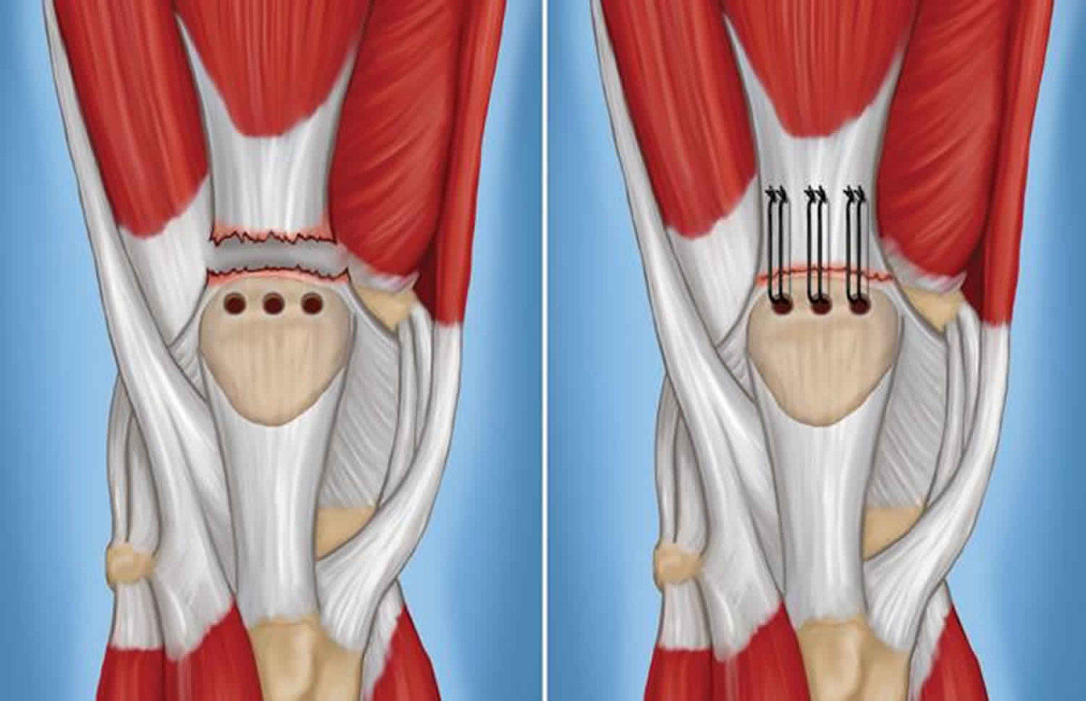 ruptured-quad-tendon-surgery-4064981775.jpg